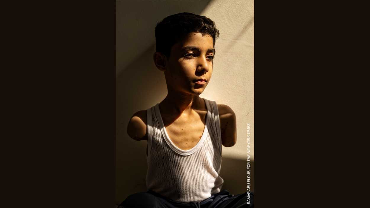 La imagen de un niño mutilado en Gaza tras un ataque israelí, elegida fotografía del año en el Word Press Photo.
